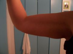 flabby arm making a muscle