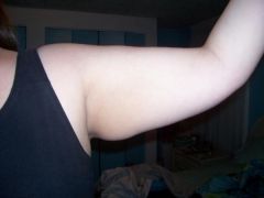 flabby arm before surgery