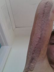 Right Arm 5 days Post Op