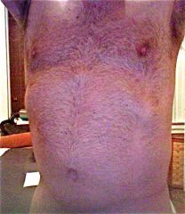 3 years after lap-band surgery / 4 months after body-lift surgery