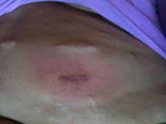 Abscess of my left surgical incision