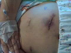 belly day 1 post op