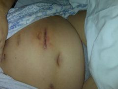Day 3 post op. Infection is hard to see but it goes up to incision right below ribcage.