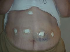 My incisions