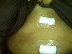 Just 2 incisions for the procedure