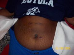 Post surgery scars...YUCK! Which is worse the post surgery scars or the pre-surgery stomach fat?