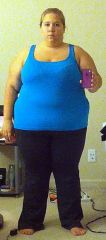 Front view: Highest weight at 295 pounds (post-op)