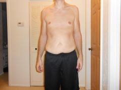Front before extended tummy tuck