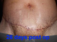 before after 5 vs 26 days post op