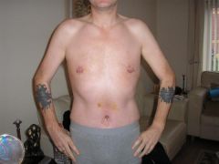 Tummy Tuck and Chest reduction DONE!