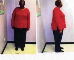 LAP-BAND? consultation picture...298 pounds! October 1997