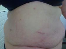 5 months post op incisions