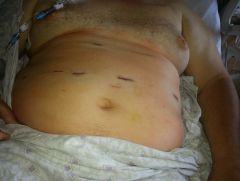 Incisions 2 hours after Surgery