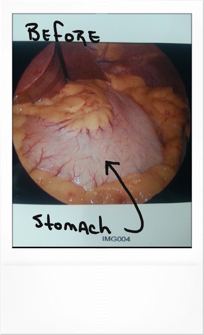 4.  stomach before surgery