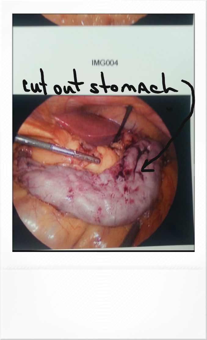 6.  stomach portion to be removed