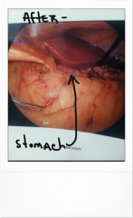 5.  stomach after surgery