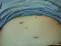 My Surgical Incisions - Day 5 - #2