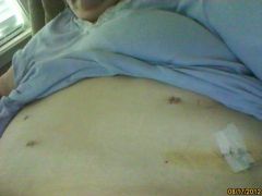 My Surgical Incisions - Day 5 - #3
