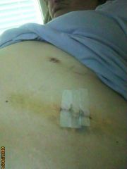My Surgical Incisions - Day 5 - #4