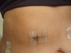 shot of incisions