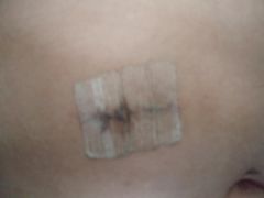 port incision close-up
