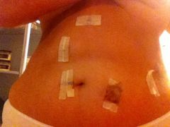 RNY incisions 04172013