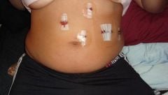 My incisions total of 5
