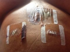 Day of surgery incision