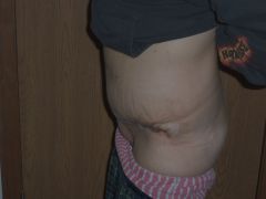 Before-After tummy tuck and panniculectomy