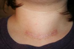 total thyroidectomy scar - 3 weeks post op