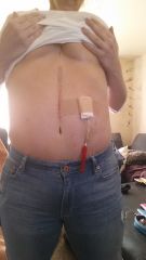 my j tube and scar from surgery to remove abcesses