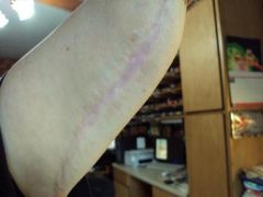 arm scar 1yr post surgery