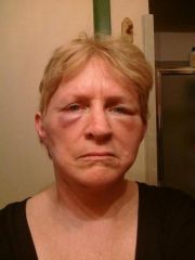 facelift day 3. This was actually the worse day for me, as far as bruising and swelling goes.