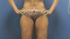 Before and After Plastic Surgery Thigh Lift done by Dr. Victor Gutierrez