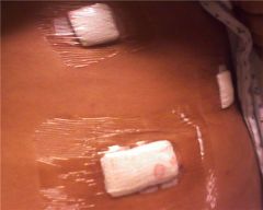 Incision sites-March 30th Day of surgery...