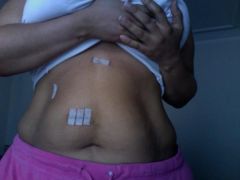 7 days after surgery- pics of my incisions with the steri strips still on
