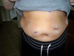 my incisions the day of