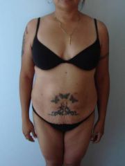 Body Lift, Breast Augmentation, Liposuction - before and afters