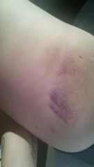 The bruises are here! - right inner thigh