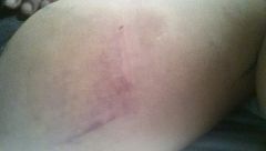 The bruises are here! - left inner thigh