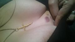 Impressive bruise in my cleavage.