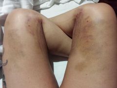 7 days post thigh lipo - looking great but SOOOO bruised!