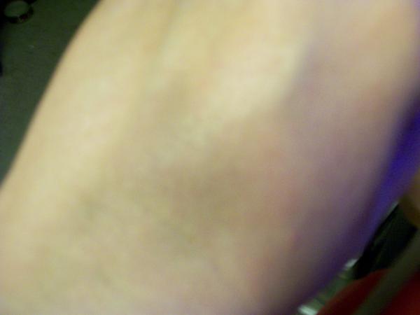 IV bruise