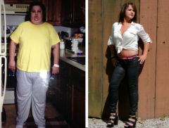 My Bariatric Life, Dr. Joseph F. Dr. Joseph F. Capella, Dr. Catherine Winslow plastic surgery after Dr. Vishal Mehta gastric bypass