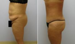My Bariatric Life before and after tummy tuck Dr. Joseph F. Capella Plastic Surgery