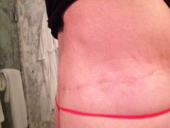 My Bariatric Life scar 19-mos post op
