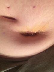 Second belly button