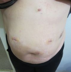 2 days post op/incisions