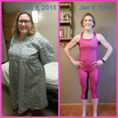 Before & After - 1 year gastric sleeve anniversary