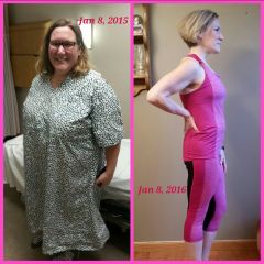 Before & After - 1 year gastric sleeve anniversary